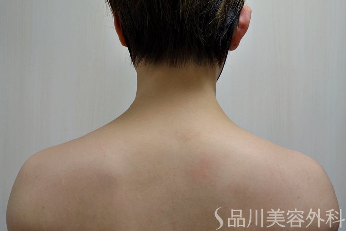 症例NO.73680のBEFORE写真