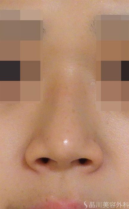 症例NO.44654のAFTER写真