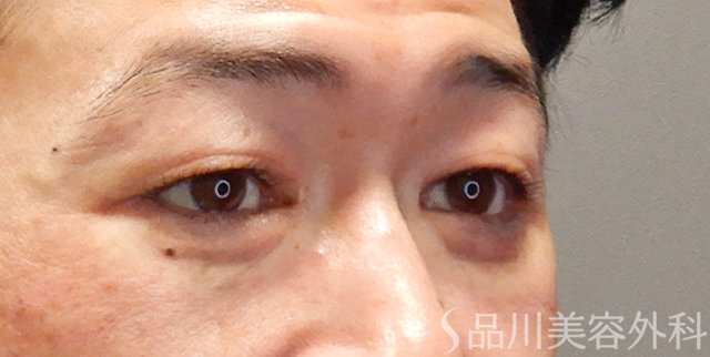 症例NO.74435のAFTER写真