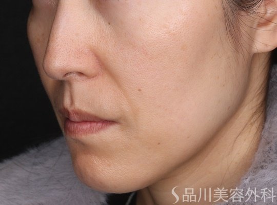 症例NO.71210のAFTER写真