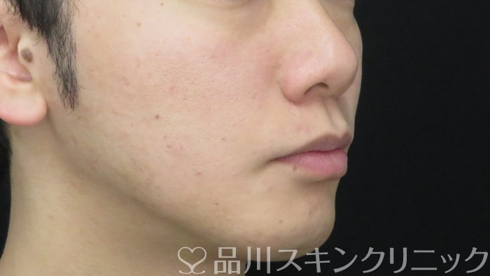 症例NO.71731のBEFORE写真