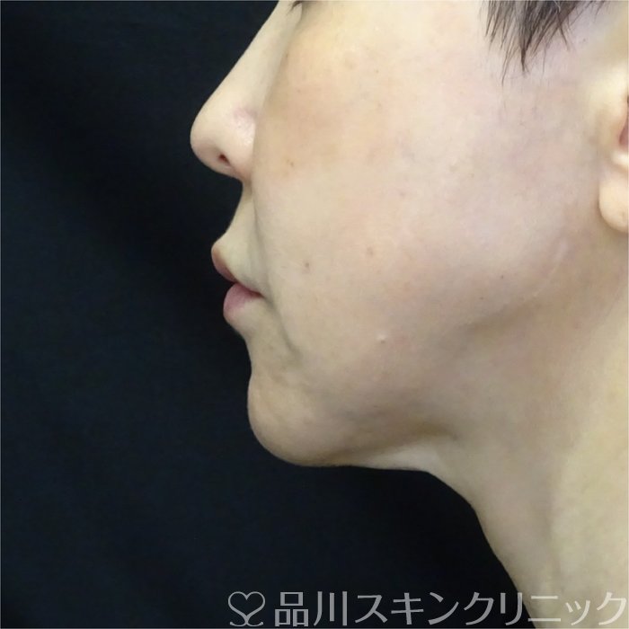症例NO.70423のBEFORE写真