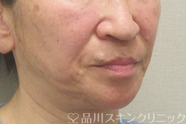 症例NO.75165のBEFORE写真
