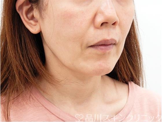 症例NO.51714のBEFORE写真