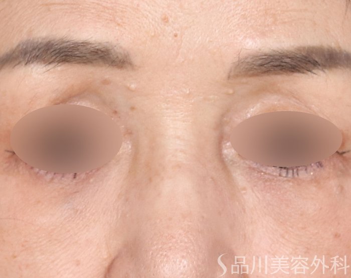 症例NO.72436のAFTER写真