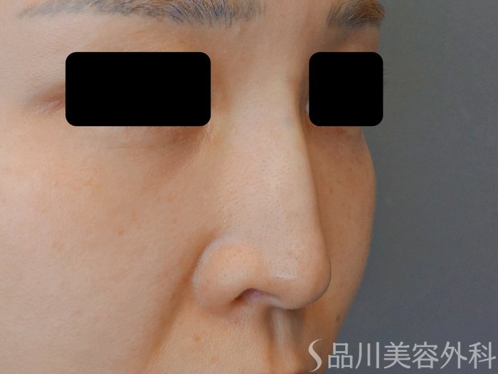 症例NO.70532のAFTER写真