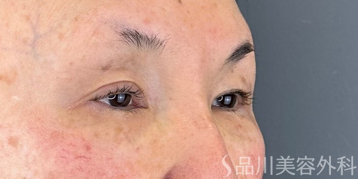 症例NO.72837のBEFORE写真