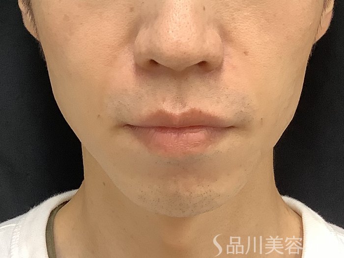 症例NO.67654のAFTER写真