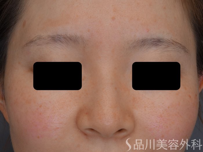症例NO.74616のAFTER写真
