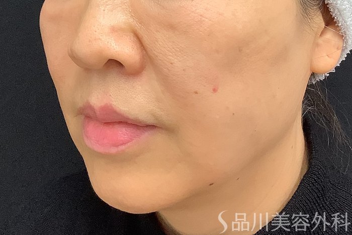 症例NO.73309のAFTER写真