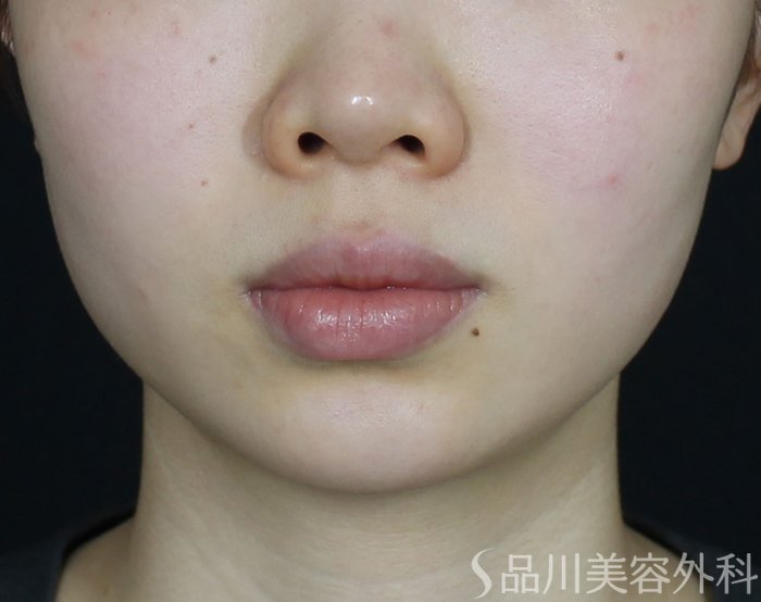 症例NO.69427のBEFORE写真