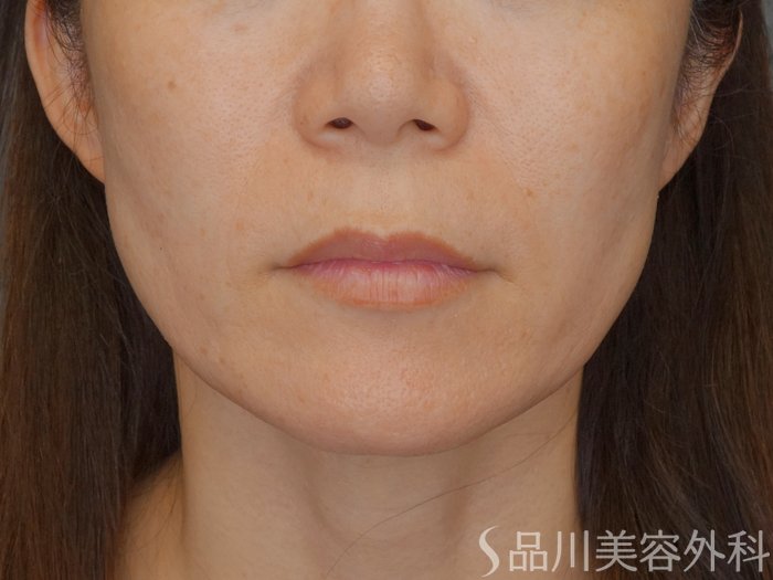 症例NO.72196のBEFORE写真