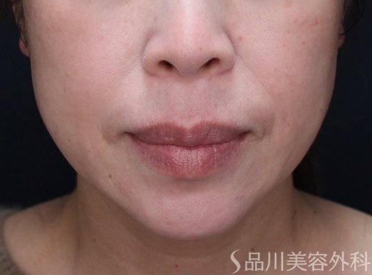 症例NO.73109のBEFORE写真