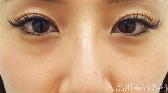 症例NO.39668のBEFORE写真