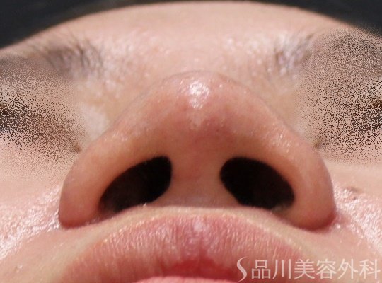 症例NO.62422のAFTER写真