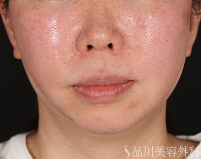 症例NO.73092のAFTER写真