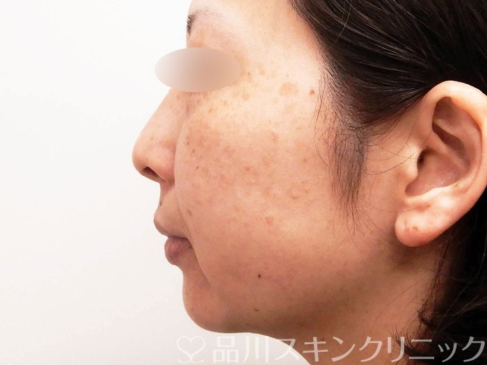 症例NO.63640のBEFORE写真