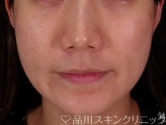 症例NO.71655のBEFORE写真