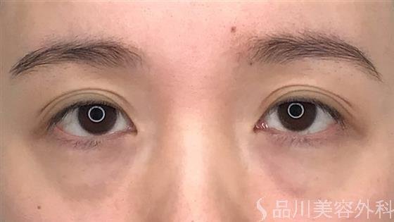 症例NO.58629のBEFORE写真