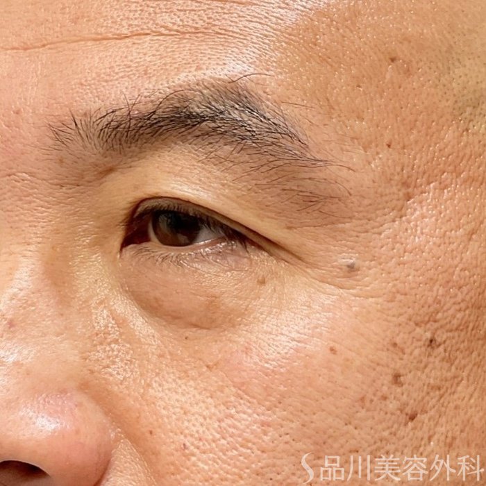 症例NO.71834のBEFORE写真