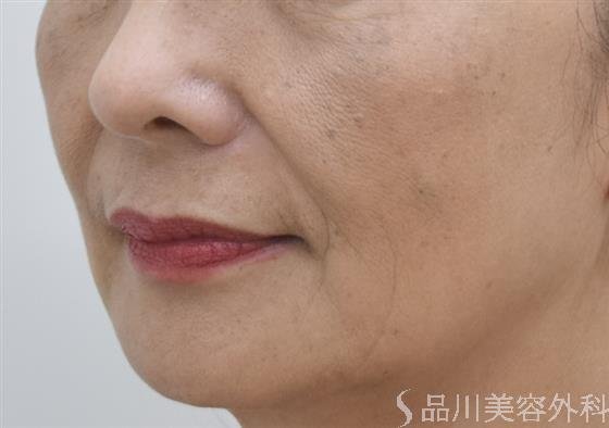 症例NO.44402のBEFORE写真