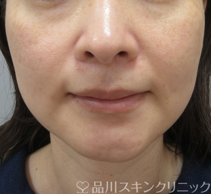 症例NO.74546のBEFORE写真