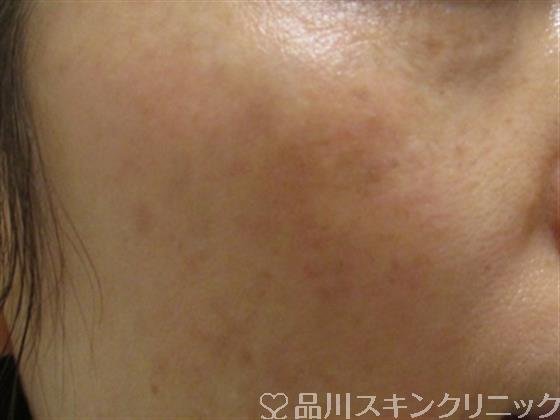 症例NO.38042のAFTER写真