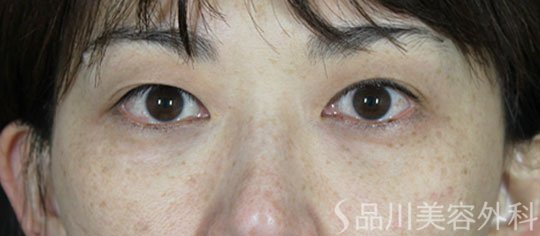 症例NO.62164のBEFORE写真