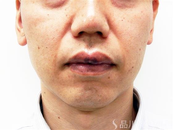 症例NO.56938のBEFORE写真