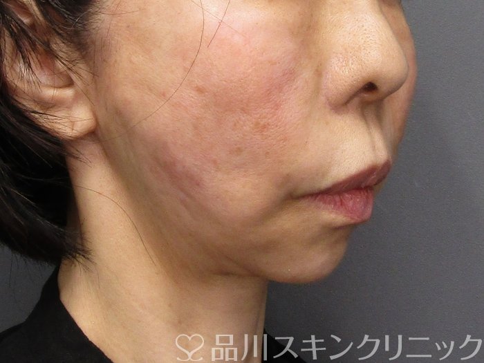 症例NO.75101のAFTER写真