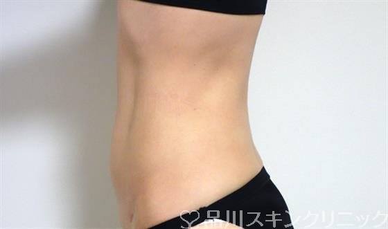 症例NO.29422のAFTER写真