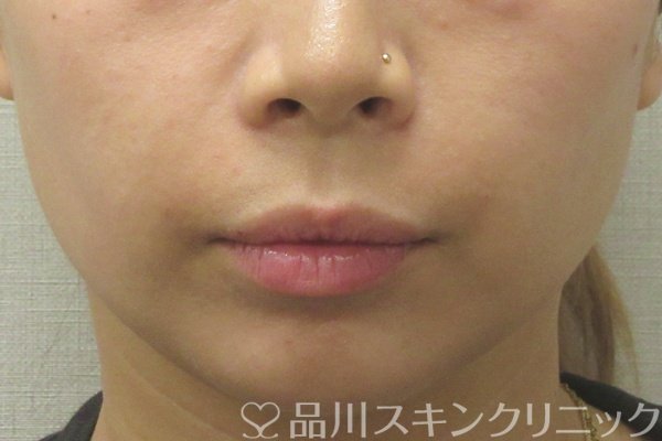 症例NO.74505のAFTER写真