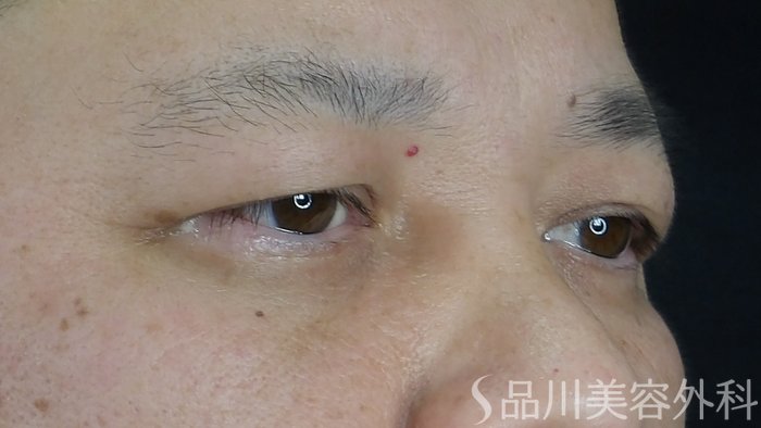症例NO.70527のBEFORE写真