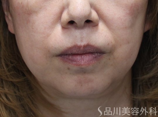 症例NO.74991のBEFORE写真