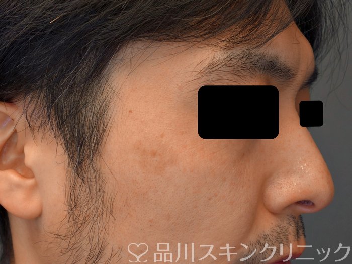 症例NO.74289のBEFORE写真