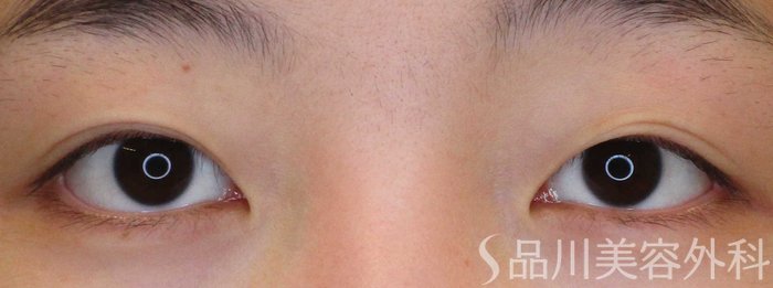 症例NO.70295のBEFORE写真