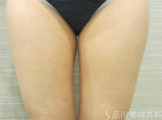 症例NO.36294のBEFORE写真