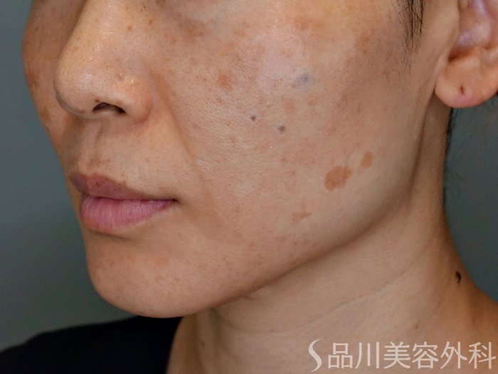 症例NO.69173のBEFORE写真