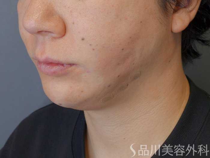 症例NO.72965のAFTER写真