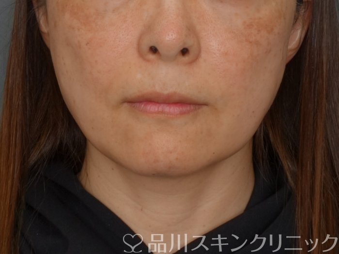 症例NO.74280のAFTER写真