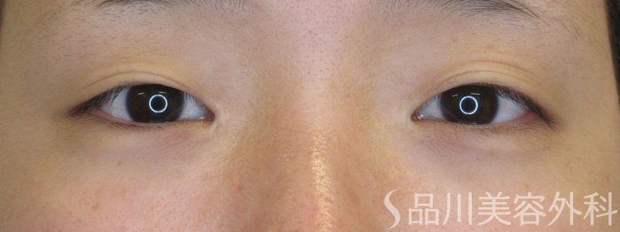 症例NO.72118のBEFORE写真