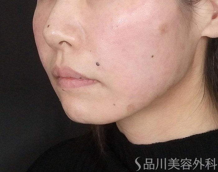 症例NO.69646のAFTER写真
