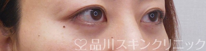 症例NO.71270のAFTER写真