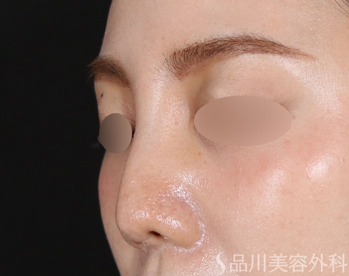 症例NO.71206のBEFORE写真
