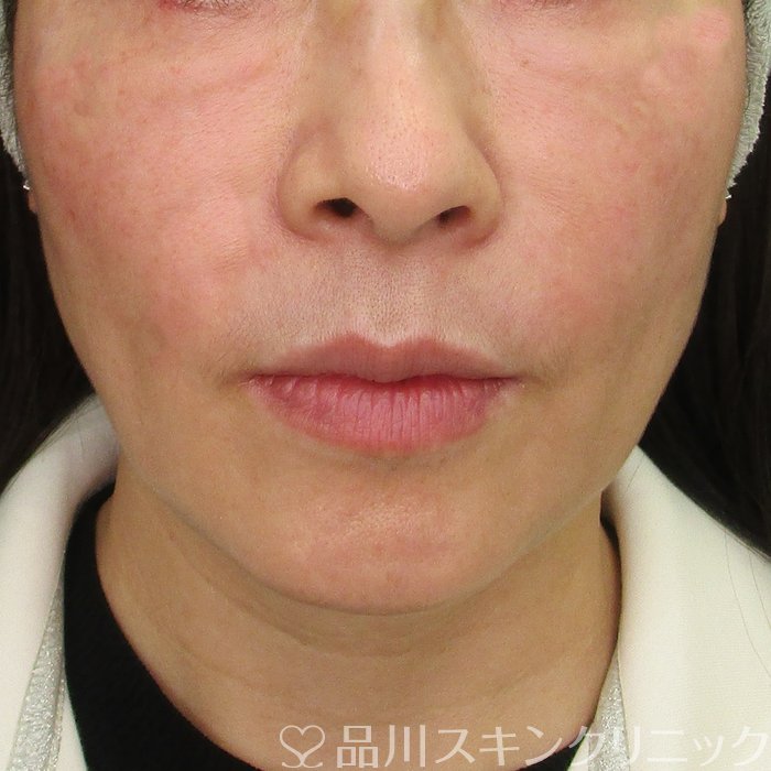 症例NO.73519のAFTER写真