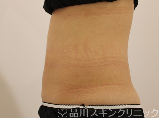症例NO.75183のAFTER写真