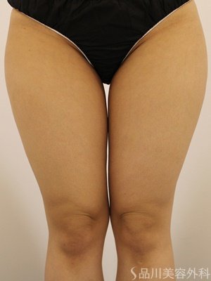 症例NO.72444のBEFORE写真