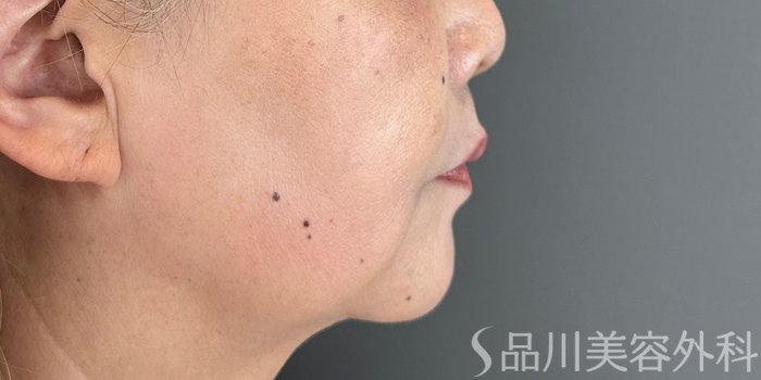 症例NO.71783のBEFORE写真