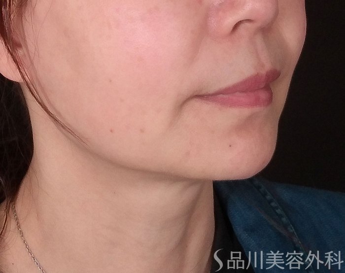 症例NO.69770のBEFORE写真