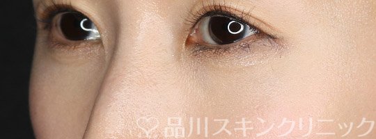 症例NO.72161のAFTER写真